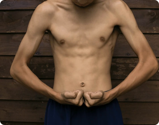 Loss-of-Muscle-Mass